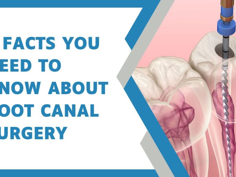 5 facts you need to know about root canal&nbsp;surgery